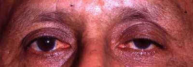 Low lid margin with a high eyelid crease, both sides โ involutional (aponeurotic) ptosis